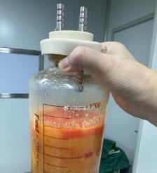 海盐水动力吸脂手术要做多久？